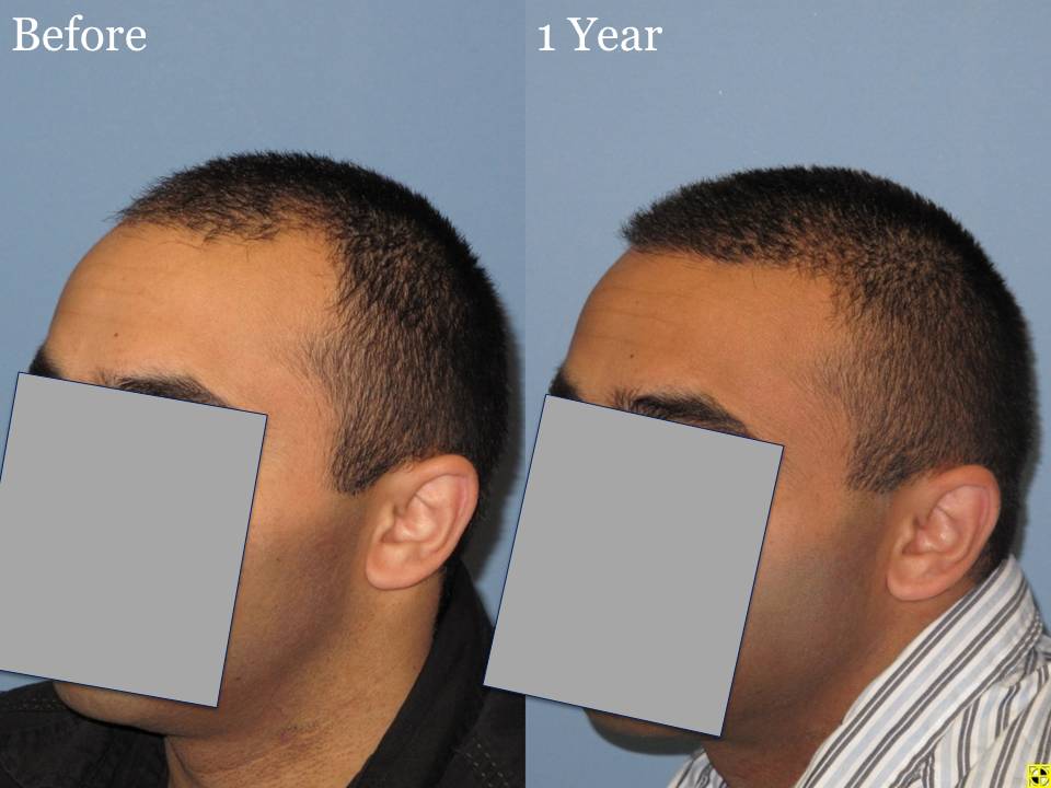 Dr. Paul Shapiro, MD  
Norwood 3A 
2160 grafts 
1 year post op