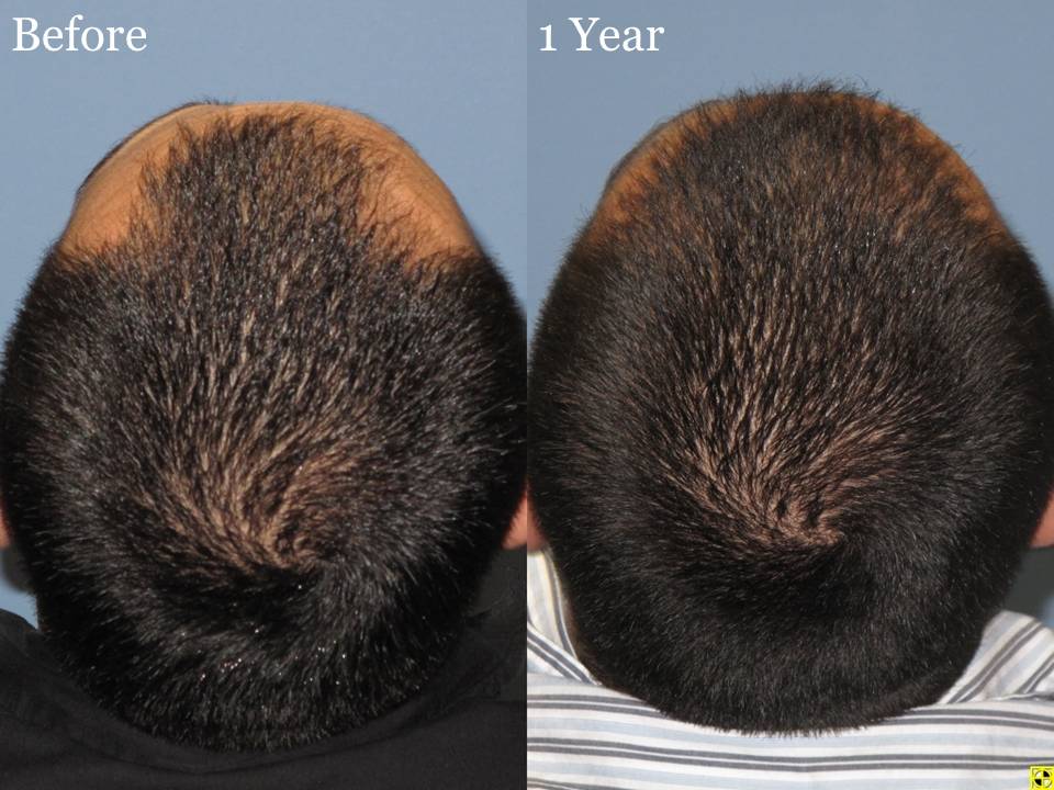 Dr. Paul Shapiro, MD  
Norwood 3A 
2160 grafts 
1 year post op