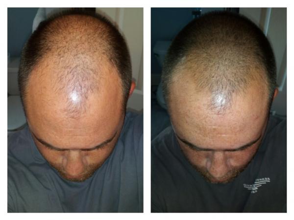 Results after 2 months 1 week on 1.25 mg Proscar, Rogaine Foam 2x daily, and Revita Shampoo with cold showers almost every day.  So far, I'm very happy with the results this early on.  You can see from the photos that my hair is less sparse on top and starting to fill out the widow's peak area.  I've had no shedding at all and no concerning side effects.  I'll update at least once a month.