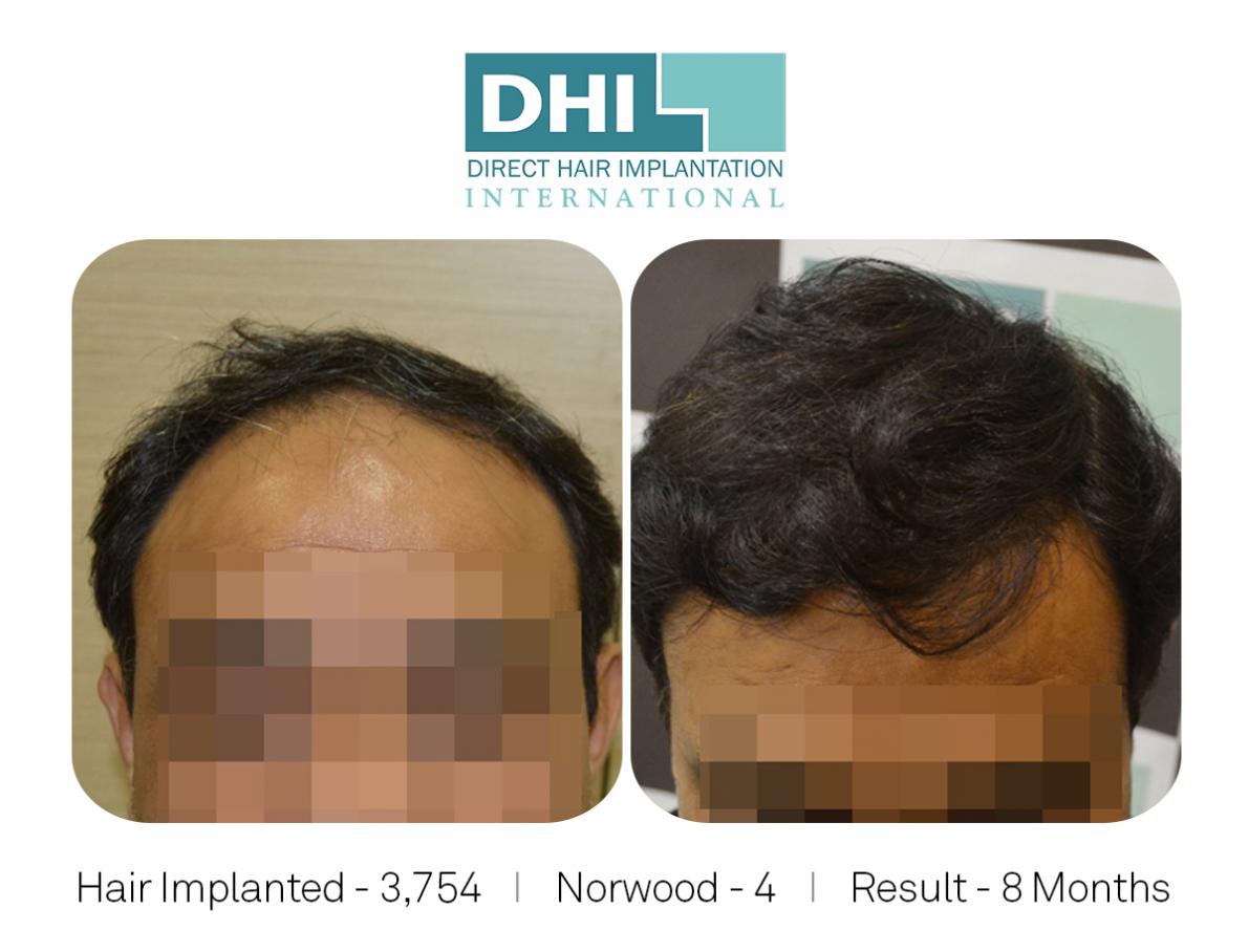 Norwoord 4, Hair Implanted 3754