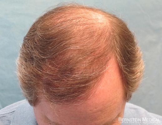 Bernstein Medical's Patient FVR, hair transplant results after one year - Top View 
 
View his full photoset >>...