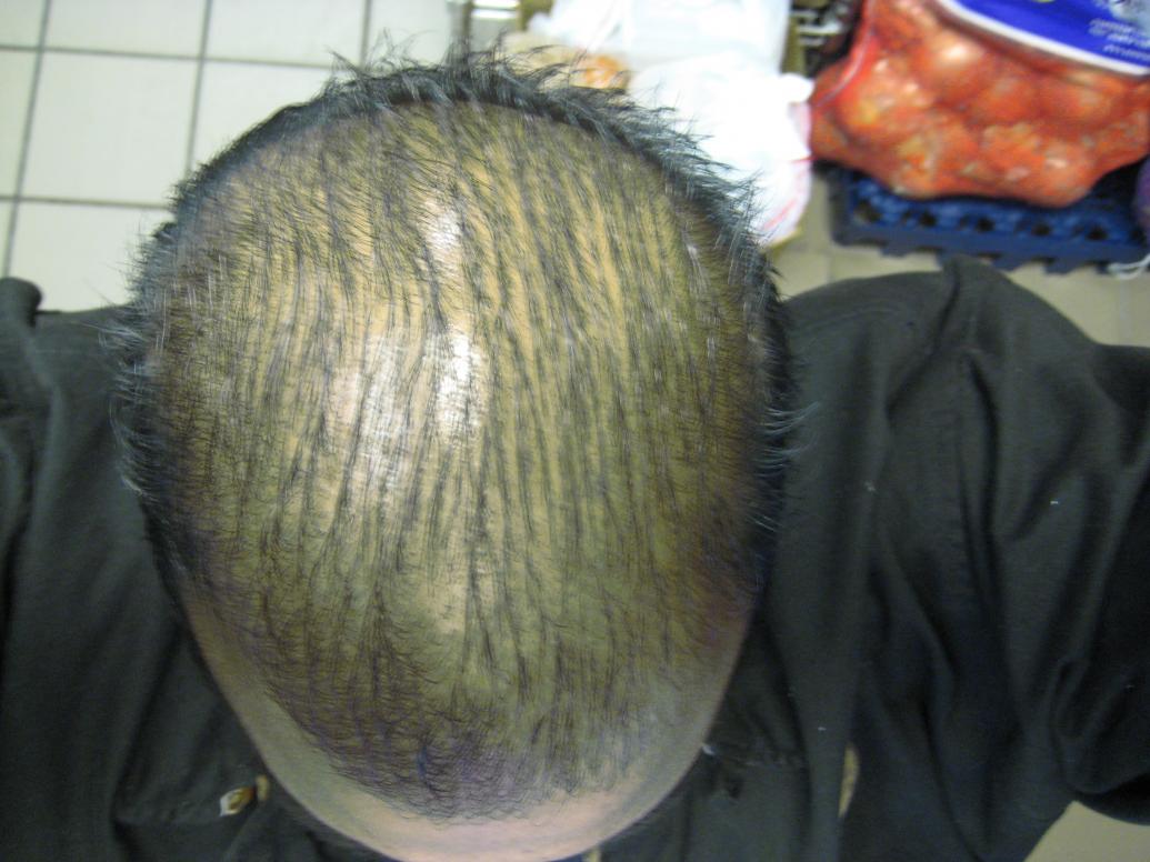Click image for larger version

Name:	My Balding Head.jpg

Size:	92.9 KB
ID:	2462