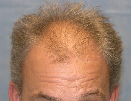 Click image for larger version

Name:	03_before-hair-transplant.jpg

Size:	57.0 KB
ID:	7530