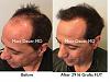 Click image for larger version

Name:	Hair Transplant Slides copy01.006.jpg

Size:	16.8 KB
ID:	50229