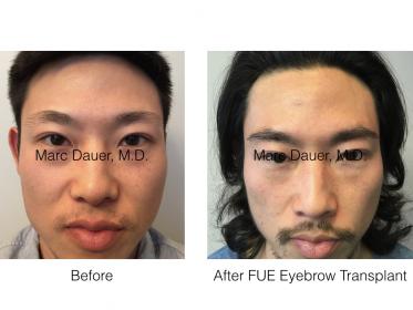 Click image for larger version

Name:	FUE eyebrows.001.jpg

Size:	15.3 KB
ID:	52752