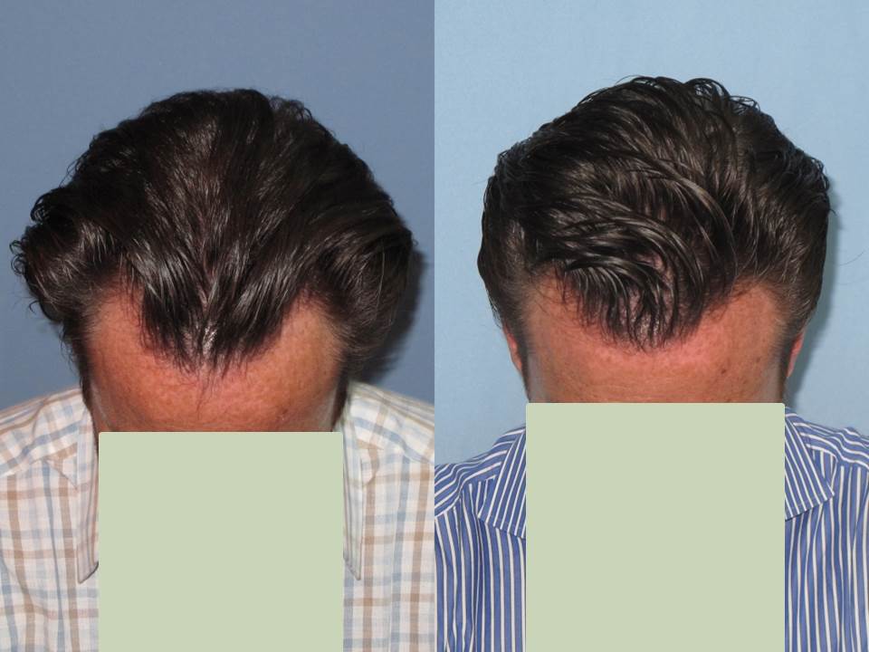 Dr. Paul Shapiro, MD 
FUT  1913 grafts 
6 months post-op