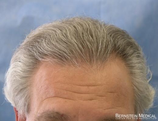 Bernstein Medical's Patient ZLA after 1st hair transplant - Detail of Hairline 
 
View his full photoset >>...