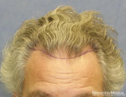 Bernstein Medical's Patient ZLA position of hairline - Detail of Hairline 
 
View his full photoset >>...