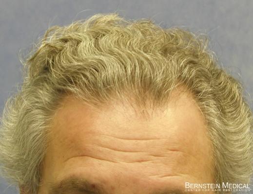 Bernstein Medical's Patient ZLA before hair transplant - Detail of Hairline 
 
View his full photoset >>...