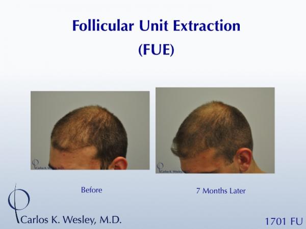 Early growth after this young man's 1701 graft FUE session with Dr. Carlos K. Wesley (NYC).  At only 7 months postoperatively, his recipient growth...