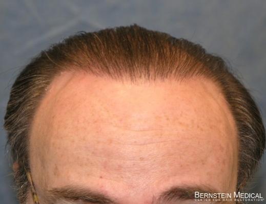 Click image for larger version

Name:	04_after-3rd-hair-transplant.jpg

Size:	22.3 KB
ID:	24976