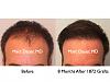 Click image for larger version

Name:	Hair Transplant Slides.470.jpg

Size:	63.5 KB
ID:	37433