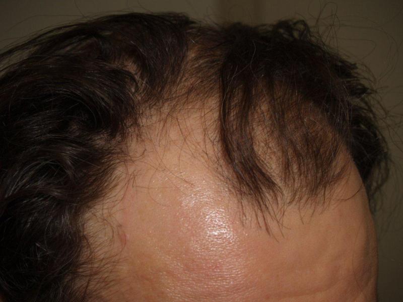 Before Hair Transplant Procedure