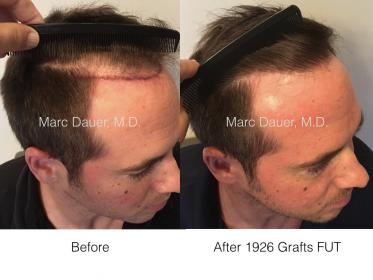 hair transplant patient of Dr. Marc Dauer