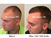 Click image for larger version

Name:	Hair Transplant Slides copy12.004.jpg

Size:	14.6 KB
ID:	43692