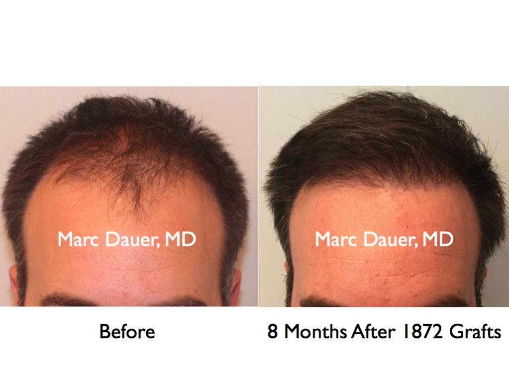 Click image for larger version

Name:	Hair Transplant Slides.470.jpg

Size:	63.5 KB
ID:	37433