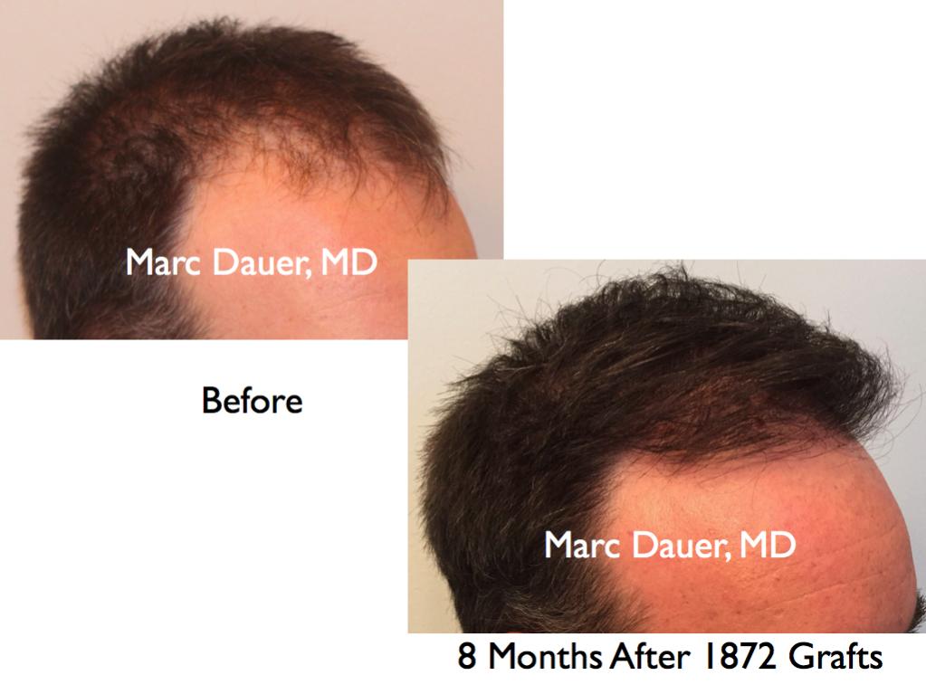 Click image for larger version

Name:	Hair Transplant Slides.472.jpg

Size:	62.9 KB
ID:	37435