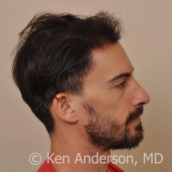 Jason Nicola	 
Norwood 3 
Age: 34 
Surgeon: Dr. Ken Anderson, MD 
Location: Atlanta, Georgia 
	 
Clinical History: 
Jasons initial consultation with...