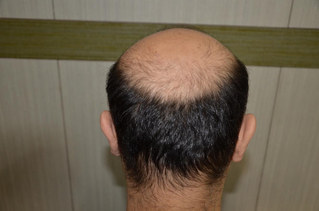 Click image for larger version

Name:	Best-FUE-hair-transplant-India (4).jpg

Size:	90.7 KB
ID:	53277