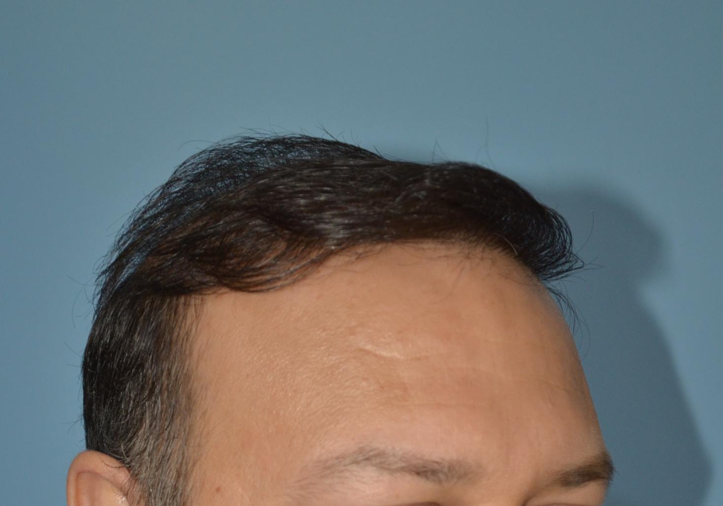 Click image for larger version

Name:	Best-FUE-hair-transplant-India (7).jpg

Size:	87.6 KB
ID:	53279