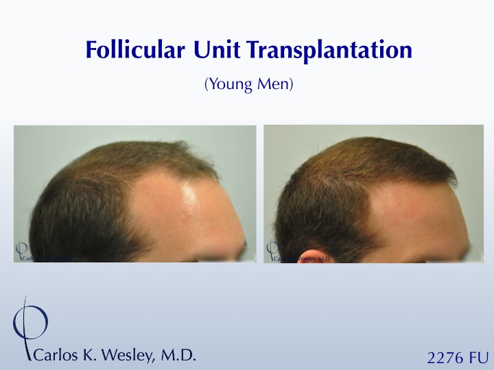 This 28-year-old desired the most natural appearing surgical hair restoration. He elected to have a session with Dr. Carlos K. Wesley in New York...