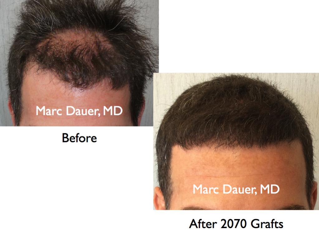 Click image for larger version

Name:	Hair Transplant Slides9.281.jpg

Size:	74.6 KB
ID:	35205
