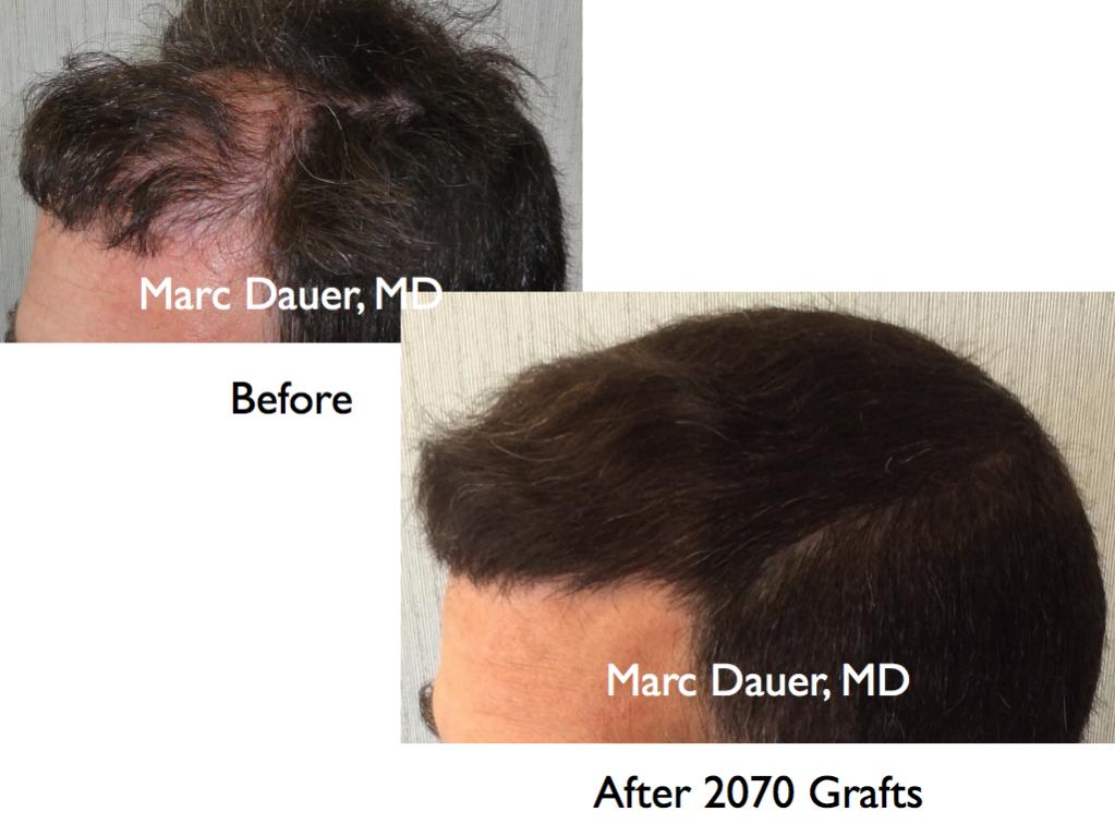 Click image for larger version

Name:	Hair Transplant Slides9.279.jpg

Size:	70.2 KB
ID:	35207