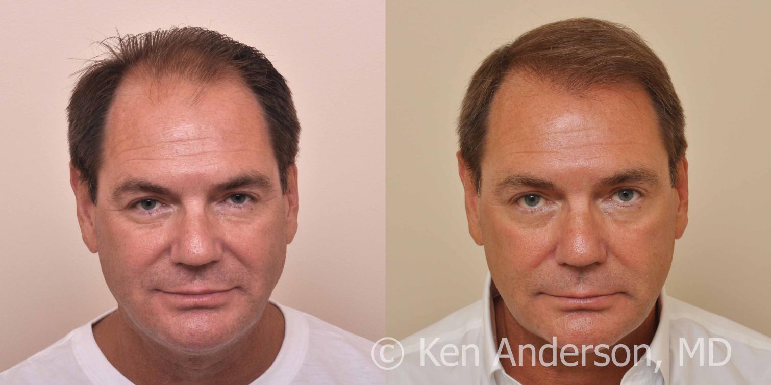 57 year old man who had an ARTAS Robotic Hair Transplant by Dr. Ken Anderson, at the Anderson Center for Hair in Atlanta, Georgia.