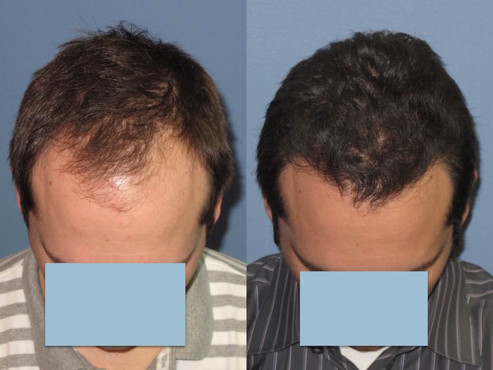 Paul Shapiro, MD 
FUT 3113 grafts 
12 months post-op