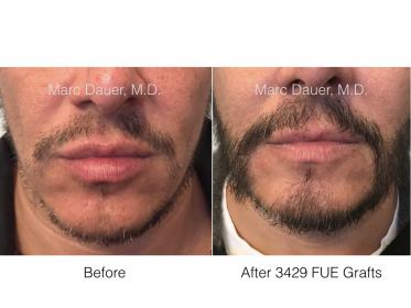 beard FUE hair transplant