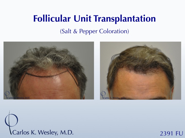 This patient is seen Before/After a 2391 graft 
session with Carlos K. Wesley, M.D. 
 
An interactive Before/After image of this patient can be...