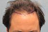 Click image for larger version

Name:	1b position of hairline.jpg

Size:	25.6 KB
ID:	35753