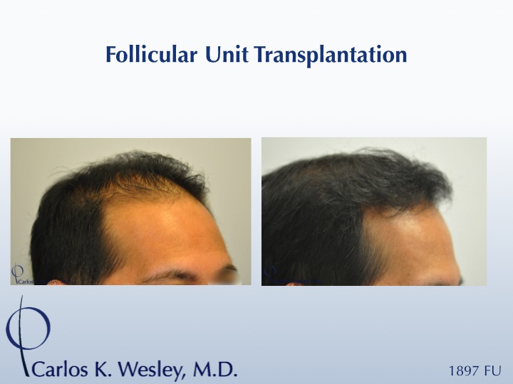 35-year-old male as seen before/after 1897 graft session with Dr. Carlos K. Wesley in NYC. 
 
A video of this patient's experience can be viewed...