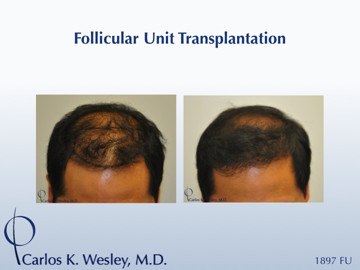 35-year-old male as seen before/after 1897 graft session with Dr. Carlos K. Wesley in NYC. 
 
A video of this patient's experience can be viewed...