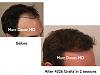 Click image for larger version

Name:	Hair Transplant Slides2.236.jpg

Size:	54.7 KB
ID:	34132