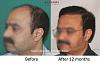 Click image for larger version

Name:	Dr-Pradeep-Sethi-Dr-Arika-Bansal-Eugenix-Result3.jpg

Size:	69.4 KB
ID:	60274