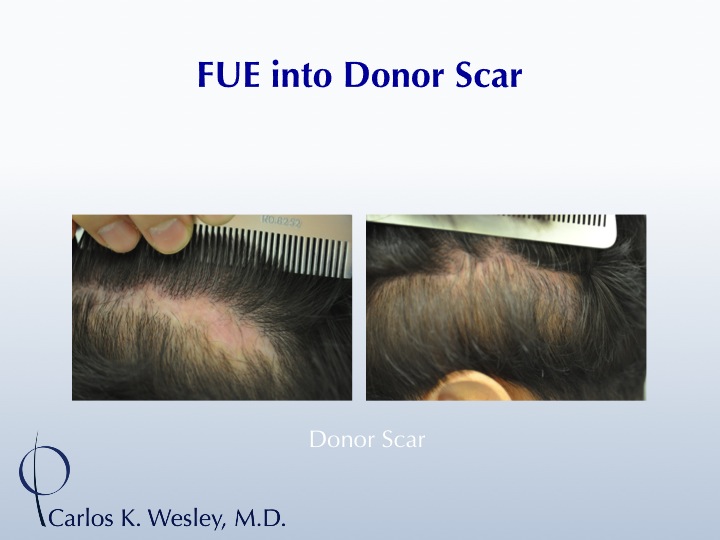 Donor scar repair by Dr. Wesley using FUE into scar tissue.