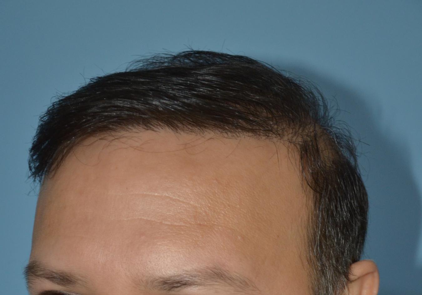 Click image for larger version

Name:	Best-FUE-hair-transplant-India (6).jpg

Size:	89.8 KB
ID:	53280