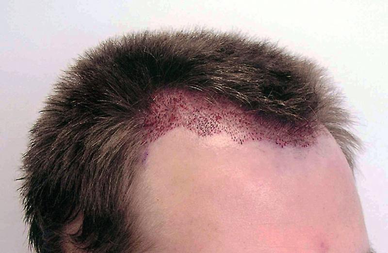 Before hair restoration / Post-op view