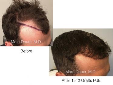 1542 FUE Grafts by Dr. Marc Dauer