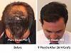 Click image for larger version

Name:	Hair Transplant Slides5.216.jpg

Size:	79.3 KB
ID:	34100