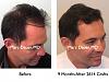 Click image for larger version

Name:	Hair Transplant Slides5.215.jpg

Size:	73.3 KB
ID:	34101