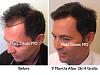 Click image for larger version

Name:	Hair Transplant Slides5.214.jpg

Size:	79.4 KB
ID:	34102