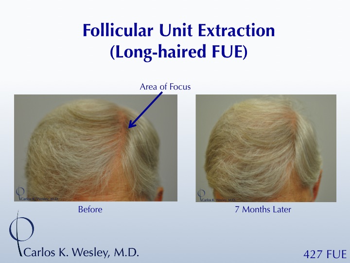 Focused, long-haired FUE