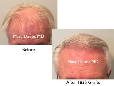 Click image for larger version

Name:	Hair Transplant Slides copy7.001.jpg

Size:	12.3 KB
ID:	45447