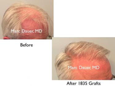 Click image for larger version

Name:	Hair Transplant Slides copy7.003.jpg

Size:	11.7 KB
ID:	45449