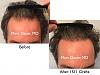 Click image for larger version

Name:	Hair Transplant Slides copy46.006.jpg

Size:	15.0 KB
ID:	46141