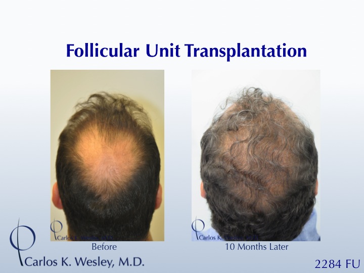 49 Yr Old Crown Coverage