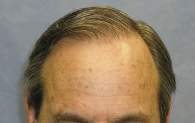 Detail of Hair Line After First Session 
 
View his full photoset >>...