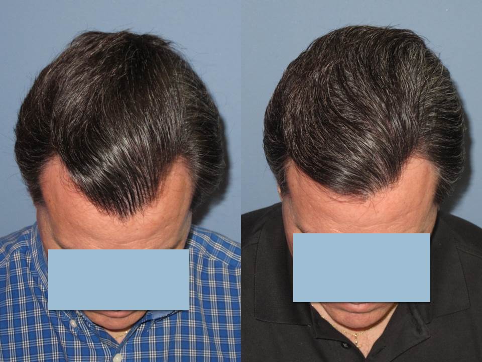 Dr. Paul Shapiro 
FUT 1395 grafts 
12 months post op